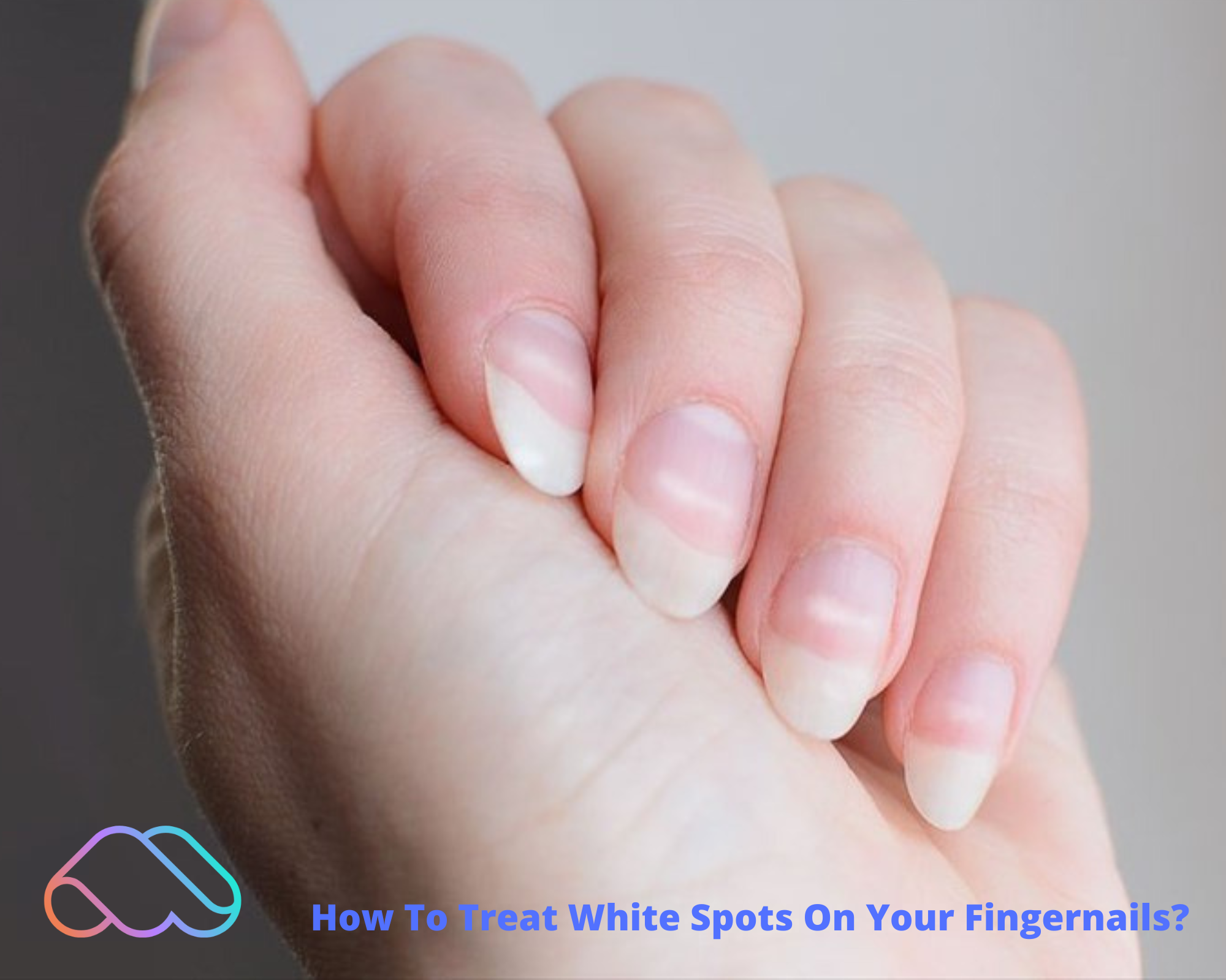 How To Treat White Spots On Your Fingernails?